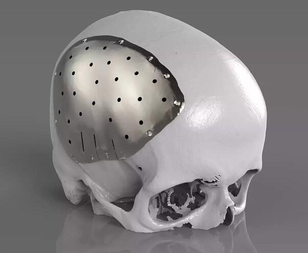 他的“脑壳”竟是3D打印出来的！